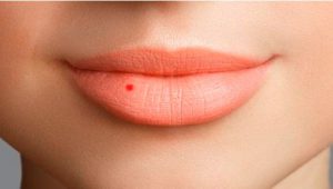 Nốt ruồi đỏ giữa trán cực hiếm có